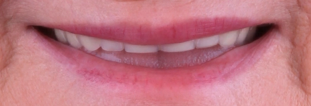 Implantes dentários em São José do Rio Preto antes1