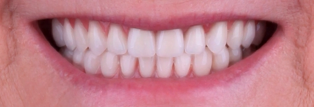 Implantes dentários em São José do Rio Preto antes2